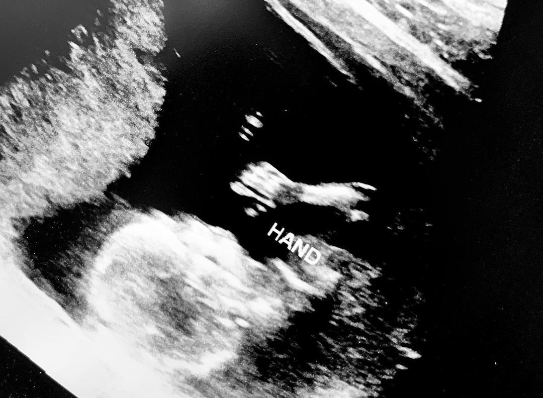 Marco Grazzini and Alvina August are expecting a baby