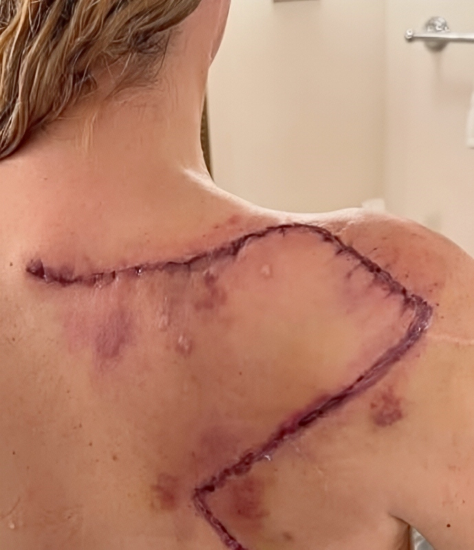 Mellencamp Recently Posted A Photo Of Her Melanoma Surgery - Instagram