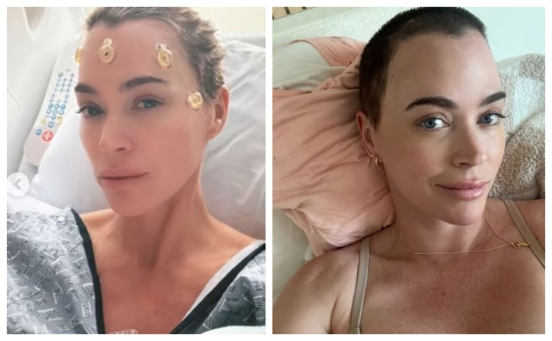 Teddi With Surgery Staples - Left - and With Them Removed - Right- Instagram